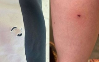 11-årig pojke blev biten av hund